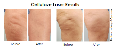 Cellulaze Results