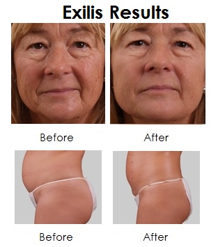 Exilis Results